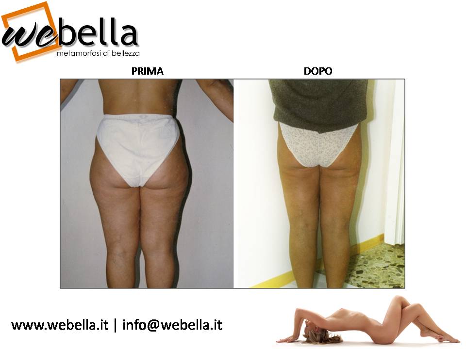 11. Liposcultura 11. Liposcultura