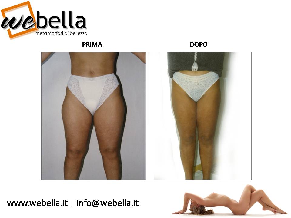 12. Liposcultura 12. Liposcultura