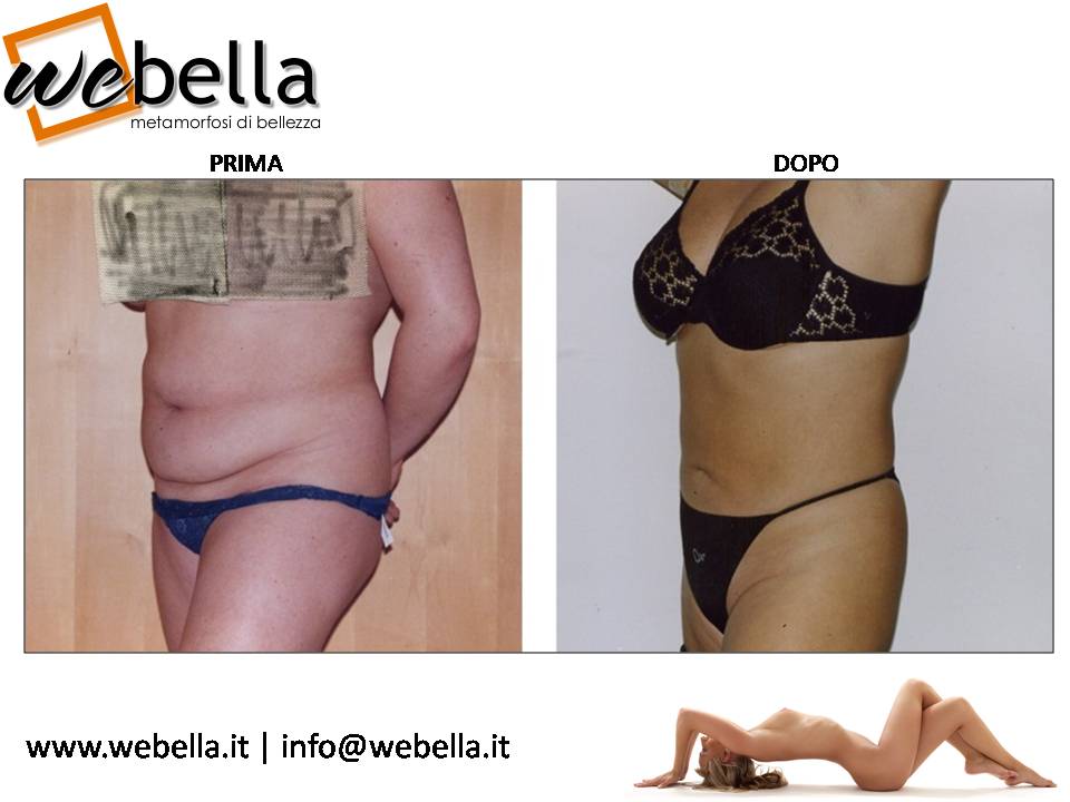 13. Liposcultura 13. Liposcultura
