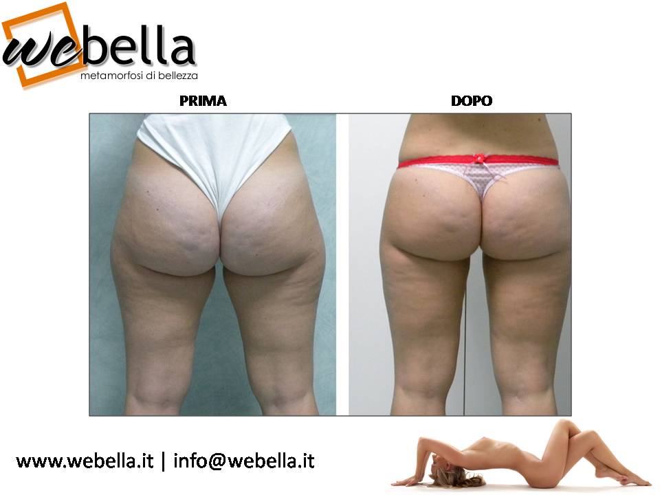 14. Liposcultura 14. Liposcultura