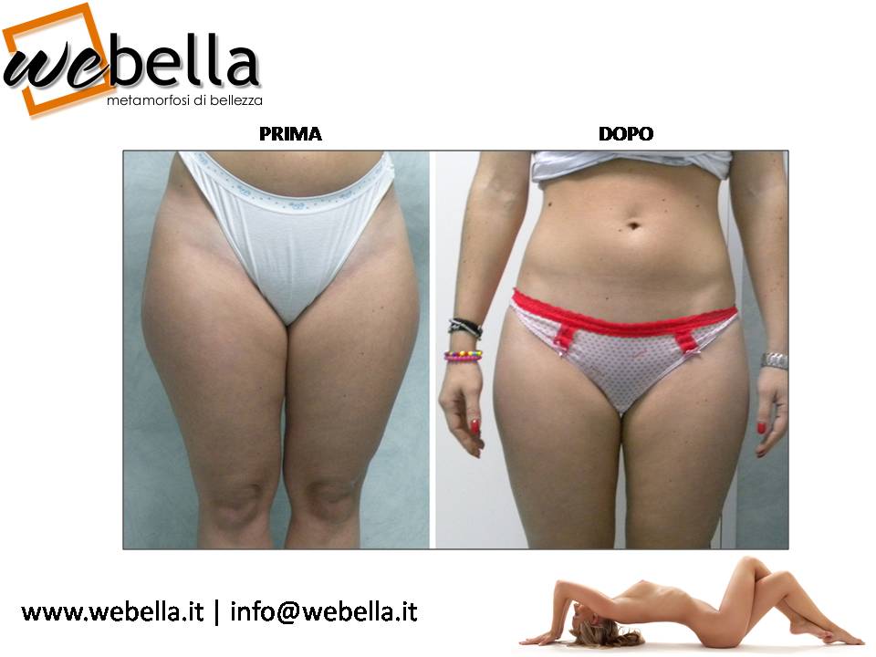 15. Liposcultura 15. Liposcultura