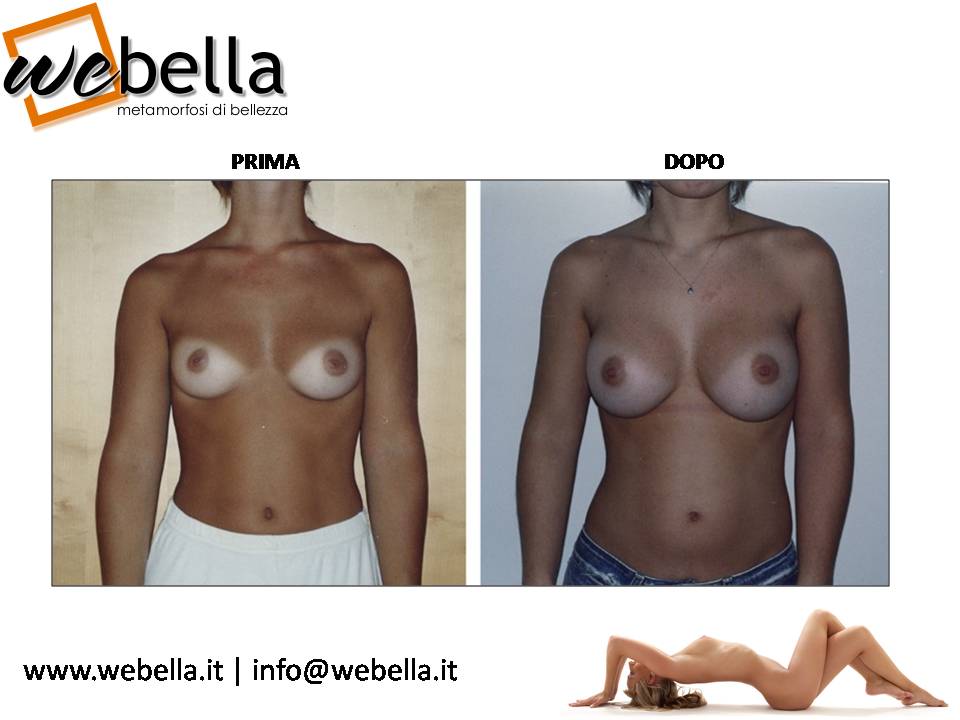 16. Mastoplastica 16. Mastoplastica