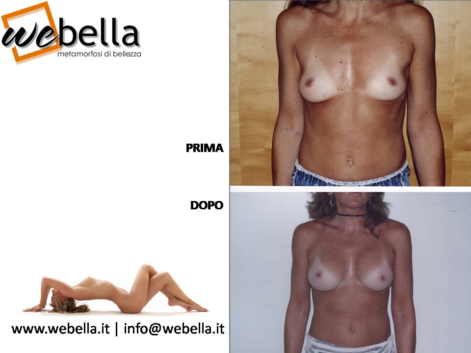 18. Mastoplastica 18. Mastoplastica