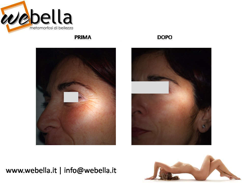 10. Tossina botulinica 10. Tossina botulinica