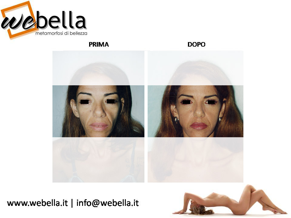 09. Lipoffiling e Blefaroplastica 09. Lipoffiling e Blefaroplastica